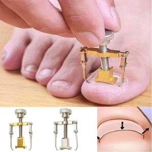 ابزار ارتودنسی ناخن